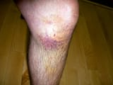 Bruised Knee